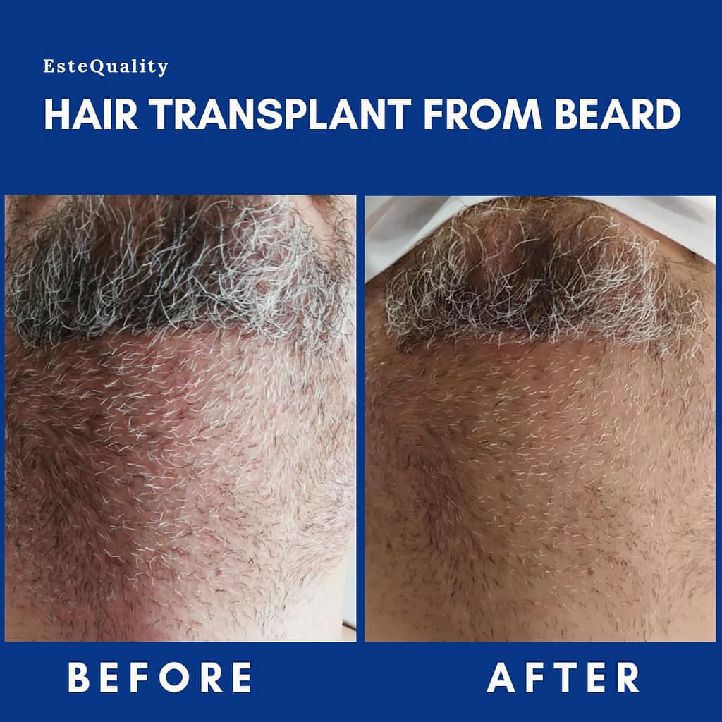 Hair Transplant From Beard