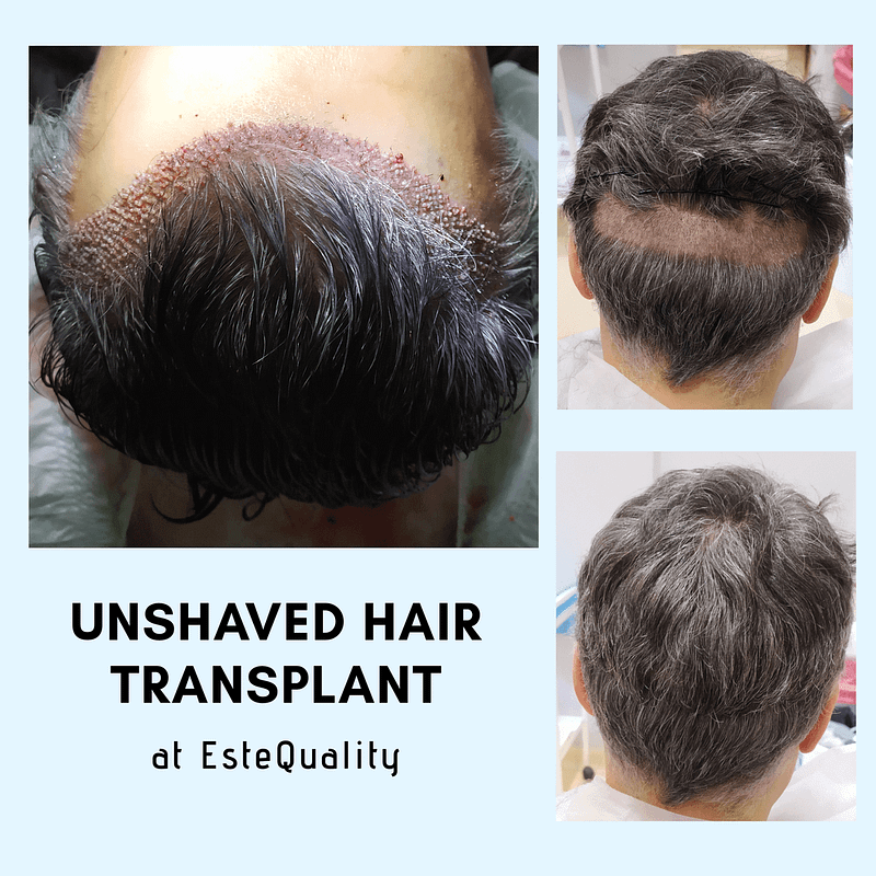 Unshaved hair transplant
