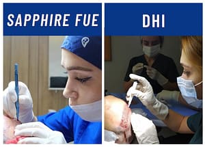 DHI and Sapphire FUE in Turkey