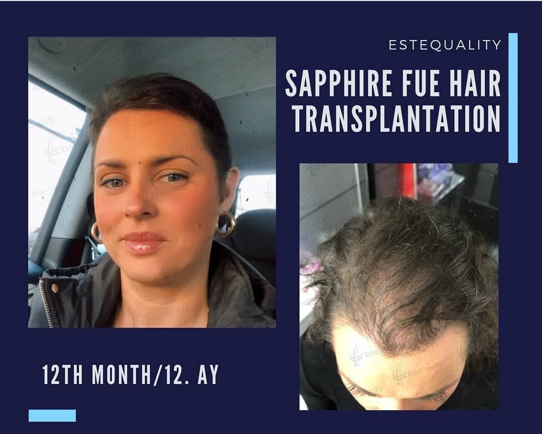 Hair Transplant for Women