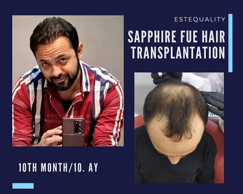 Sapphire FUE Hair Transplant