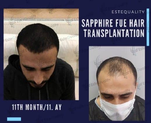 Sapphire FUE hair transplant in Turkey