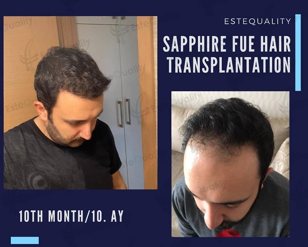 Sapphire FUE Hair Transplant in Turkey