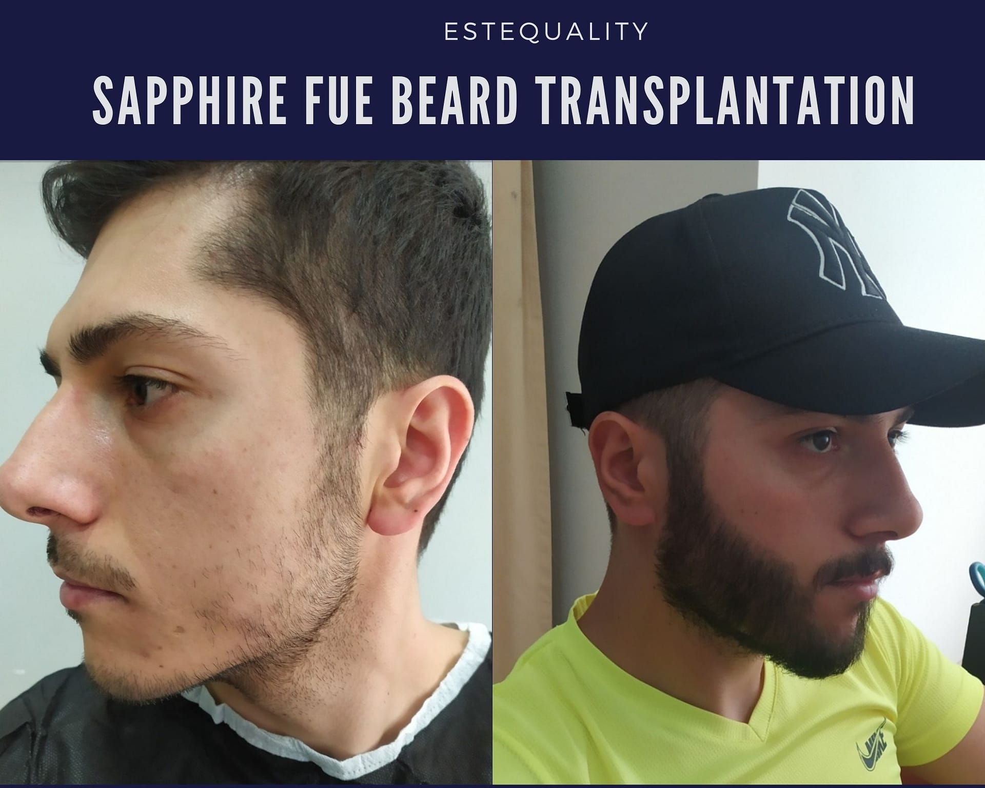 Sapphire FUE Beard Transplant in Turkey